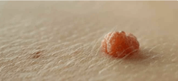 Vírus de Papilloma