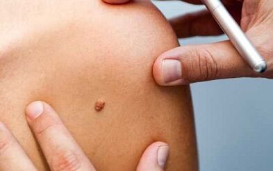 Métodos de tratamento de Papillomas