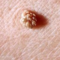 papilomavírus humano na pele