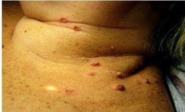 Fotos de muitos papilomas em mulheres