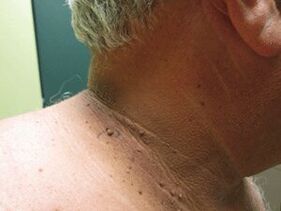 As razões para o aparecimento de papilomas plurais no corpo