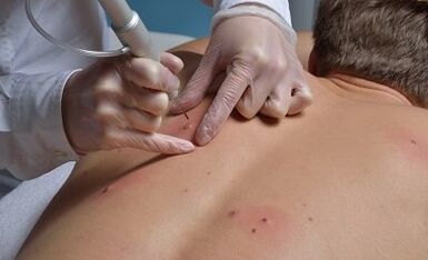 maneiras de remover papilomas