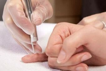 como se livrar de papilomas no corpo