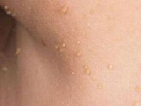 razões para o aparecimento de papilomas no corpo