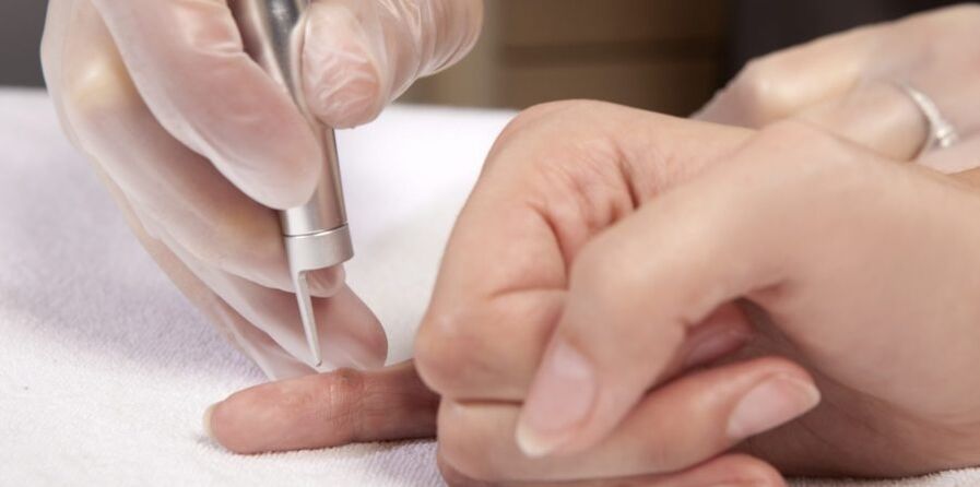 maneiras de remover papilomas nas mãos e por que eles são perigosos