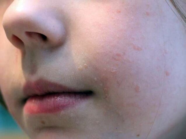 As verrugas planas no rosto aparecem com mais frequência durante a adolescência