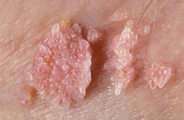 O papiloma é uma formação benigna semelhante a um tumor da pele e das membranas mucosas de natureza verrucosa