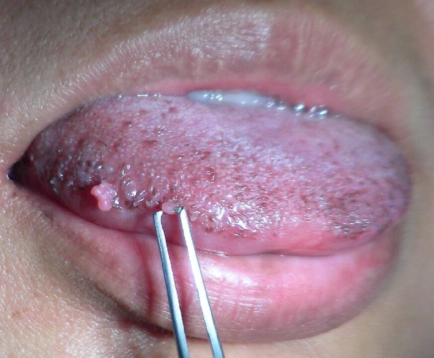 Papilomas na língua